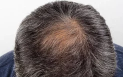 男性脱发是什么原因引起的？按摩助长你的秀发