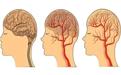 发烧抽搐是癫痫的一大诱因吗？预防癫痫避免这三个刺激