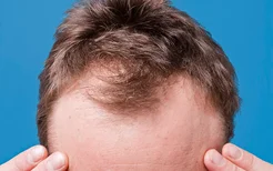 治疗脱发要避开哪些误区？推荐治疗脱发的三个偏方