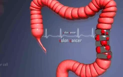 结直肠癌早期诊断