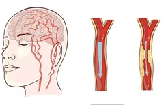 想要预防症状性癫痫综合征？先了解下这些病因