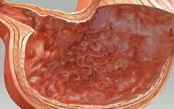 胃癌与饮食有关吗？预防胃癌要注意饮食这四点！