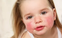 孩子为什么会花粉过敏,花粉过敏是流行病吗
