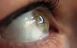 白眼球有血丝是什么原因造成的？白眼球有血丝常见5大病因