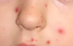 鼻子下面长痘痘是什么原因