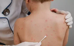 慢性荨麻疹的治疗方法有哪些