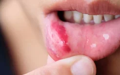 口腔溃疡初期怎么治愈？多吃水果就能远离口腔溃疡了吗？