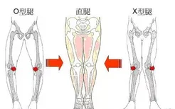 5种走路姿势会让你变成O型腿