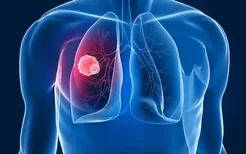 胳膊疼可能是肺癌?肺癌早期症状有哪些？