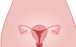 宫颈癌晚期如何治疗
