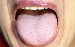 舌苔厚是什么原因