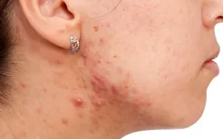 湿疹的常见症状有哪些