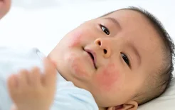 婴儿湿疹怎么处理？婴儿湿疹的治疗方法
