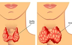 甲状腺瘤患者的常用食疗