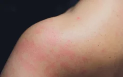 小儿湿疹或许是护肤品惹的祸,如何做好患儿护理