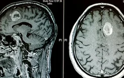 癫痫病患者如何通过饮食来调节病情？