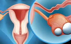 子宫颈癌的普遍症状是什么？