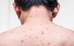 湿疹的临床表现有哪些