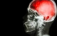 脑梗塞患者通常有4大表现,脑梗的恢复期治疗措施有哪些？