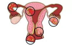子宫颈癌的初期症状是什么？