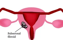 反复流产子宫颈癌的概率高，感染HPV是子宫颈癌吗？