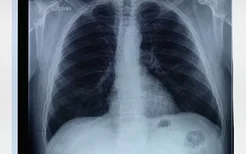 肺泡动脉氧分压差高是怎么回事？